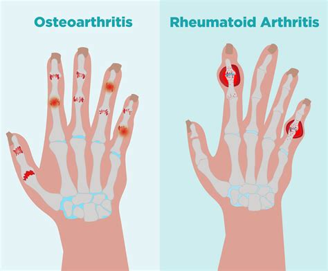 osteoartrit ve artrit